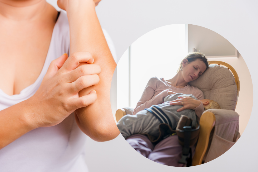 Breastfeeding and eczema